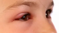 Co zrobić, jeśli midge upadł lub ubił się w oku